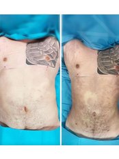 Liposuction - Zaren Clinic
