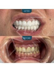 Teeth Whitening - Zaren Clinic
