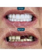 Dental Implants - Zaren Clinic
