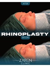 Rhinoplasty - Zaren Clinic