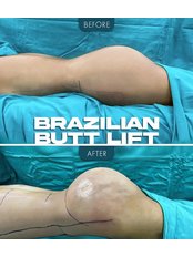 BBL - Brazilian Butt Lift - Zaren Clinic