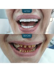 Dental Bonding - Zaren Clinic