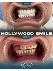 Hollywood Smile - Zaren Clinic
