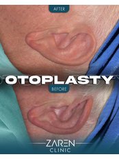 Otoplasty - Zaren Clinic