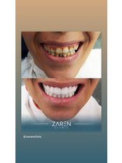 Dental Implants - Zaren Clinic