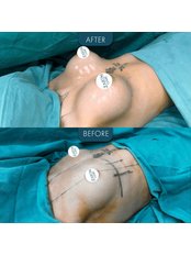 Breast Implants - Zaren Clinic