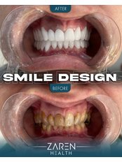 Hollywood Smile - Zaren Clinic