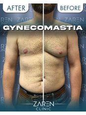 Gynecomastia - Zaren Clinic