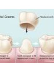 Dental Crowns - Zaren Clinic