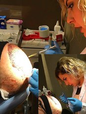 Haartransplantation - CosmetiCity