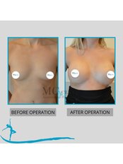 Breast Implants - Mehmet Ceber Clinic