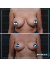 Breast Lift - Askeroglu Health Group