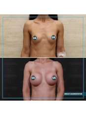 Breast Implants - Askeroglu Health Group