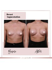Breast Implants - Askeroglu Health Group