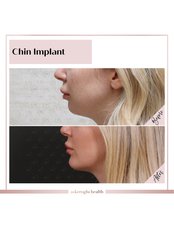 Chin Implant - Askeroglu Health Group