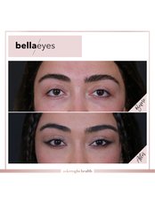 Bella Eyes (Endoscopic Brow and Eye lift) - Askeroglu Health Group