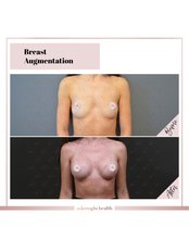 Breast Implant Revision - Askeroglu Health Group