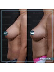 Breast Lift - Askeroglu Health Group