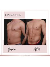 Liposuction - Askeroglu Health Group