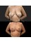 Assoc. Prof. Dr. Ulas Bali Clinic - Breast Lift 