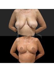 Breast Lift - Assoc. Prof. Dr. Ulas Bali Clinic