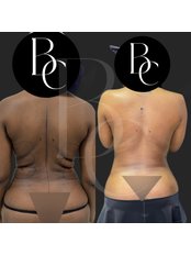 Liposuction - Assoc. Prof. Dr. Ulas Bali Clinic