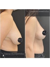 Breast Reduction - ​ Assoc. Prof. Osman Kelahmetoglu - Plastic Surgery Clinic