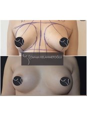 Breast Implants - ​ Assoc. Prof. Osman Kelahmetoglu - Plastic Surgery Clinic