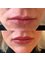 Babuccu Global Aesthetics - Lip filler 