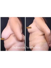 Breast Reduction - Babuccu Global Aesthetics