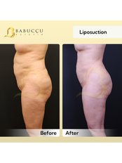 Liposuction - Babuccu Global Aesthetics