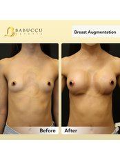 Breast Implants - Babuccu Global Aesthetics