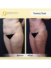 Tummy Tuck - Babuccu Global Aesthetics