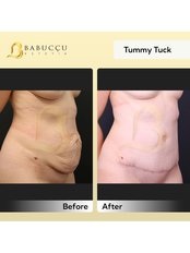 Tummy Tuck - Babuccu Global Aesthetics