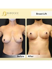 Breast Lift - Babuccu Global Aesthetics