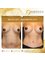 Babuccu Global Aesthetics - Breast Lift 