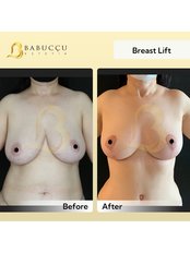 Breast Lift - Babuccu Global Aesthetics