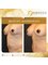 Babuccu Global Aesthetics - Breast lift 