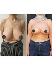 Breast Lift - Bali Clinic