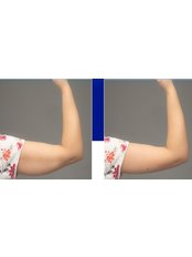 Arm Lift - Dorak Clinic