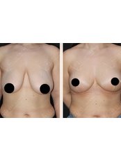 Breast Lift - Dr Ali Cetinkaya Clinic