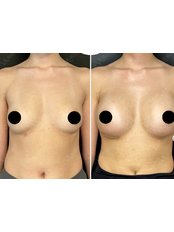 Breast Implants - Dr Ali Cetinkaya Clinic