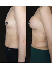 Breast Implants - Dr Burak  Pasinlioglu