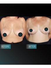 Breast Reduction - Dr Burak  Pasinlioglu