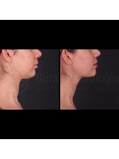 Double Chin Surgery - Dr Burak  Pasinlioglu