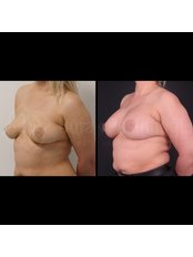 Breast Implants - Dr Burak  Pasinlioglu