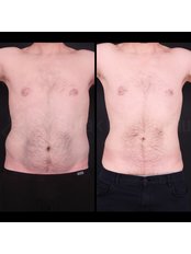 Liposuction - Dr Burak  Pasinlioglu