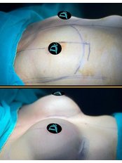 Breast Implants - Dr Devran İğrek