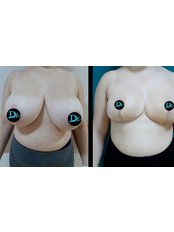 Breast Reduction - Dr Devran İğrek