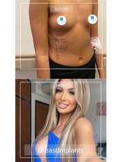 Breast Implants ( Polytech / Mentor) - Dr Erkin Onsal - Privacy Aesthetic Clinic